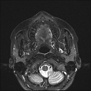 File:Basal cell carcinoma - nasal region (Radiopaedia 70292-80365 Axial STIR 18).jpg