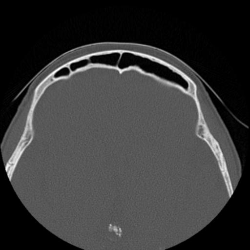 File:Base of skull chondrosarcoma (Radiopaedia 30410-31071 Axial bone window 39).jpg