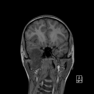Base of skull rhabdomyosarcoma (Radiopaedia 32196-33142 Coronal T1 14).jpg