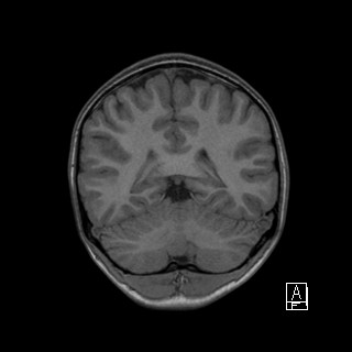 Base of skull rhabdomyosarcoma (Radiopaedia 32196-33142 Coronal T1 35).jpg