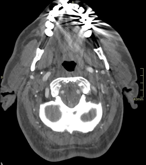 Basilar artery aneurysm (Radiopaedia 56261-62932 A 32).jpg