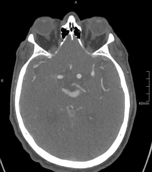 File:Basilar artery aneurysm (Radiopaedia 56261-62932 A 78).jpg