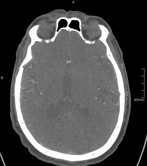 Basilar artery aneurysm (Radiopaedia 56261-62932 A 85).jpg