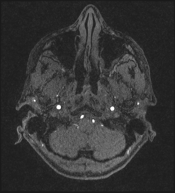 Basilar artery perforator aneurysm (Radiopaedia 82455-97733 Axial MRA 32).jpg