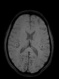 Basilar artery perforator aneurysm (Radiopaedia 82455-97733 Axial SWI 34).jpg