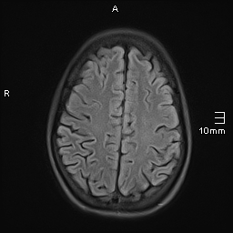 File:Basilar artery perforator aneurysm (Radiopaedia 82455-99523 Axial FLAIR 17).jpg