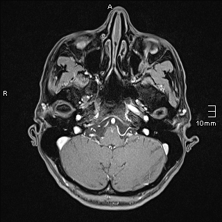 Basilar artery perforator aneurysm (Radiopaedia 82455-99523 G 18).jpg