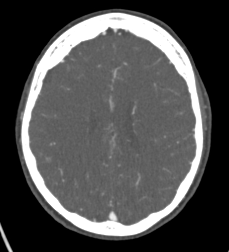 File:Basilar tip aneurysm with coiling (Radiopaedia 53912-60086 A 98).jpg