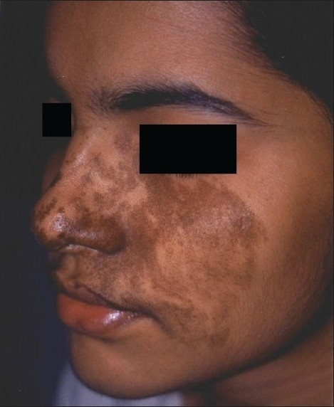 File:Beckers melanosis on face.png
