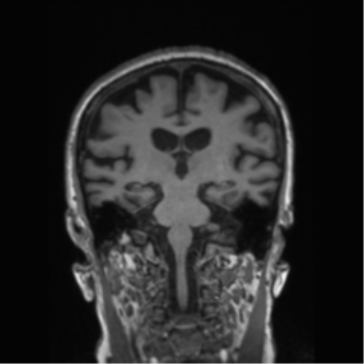 Behavioral variant frontotemporal dementia and late onset schizophrenia (Radiopaedia 52197-58083 Coronal T1 44).png