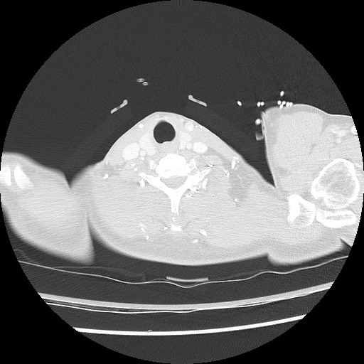 Benign post-traumatic pseudopneumoperitoneum (Radiopaedia 71199-81495 Axial lung window 5).jpg