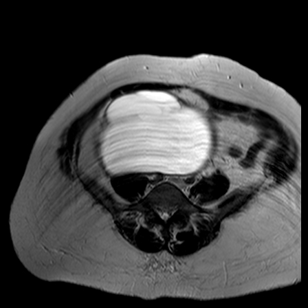 File:Benign seromucinous cystadenoma of the ovary (Radiopaedia 71065-81300 B 17).jpg