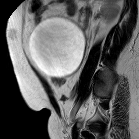 File:Benign seromucinous cystadenoma of the ovary (Radiopaedia 71065-81300 Sagittal T2 6).jpg