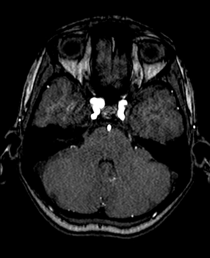 Berry aneurysm of the terminal internal carotid artery (Radiopaedia 88286-104918 Axial TOF 82).jpg