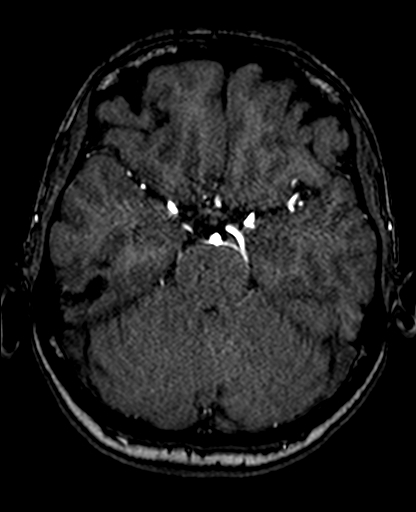 File:Berry aneurysm of the terminal internal carotid artery (Radiopaedia 88286-104918 Axial TOF 95).jpg