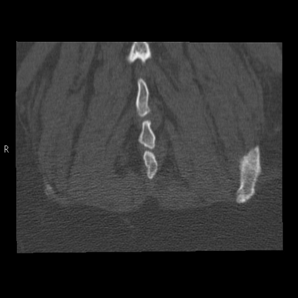 Bertolotti syndrome (Radiopaedia 24864-25128 Coronal bone window 47).jpg
