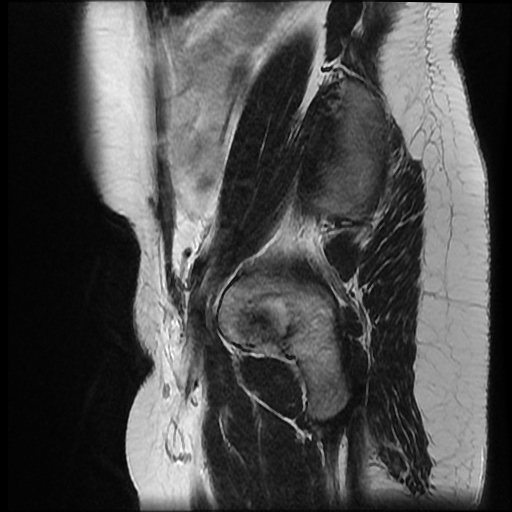 File:Bicornuate uterus (Radiopaedia 51676-57472 Sagittal T2 4).jpg