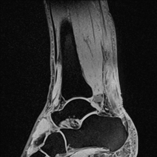 File:Bilateral Achilles tendon complete tear (Radiopaedia 81344-95051 Sagittal WE - Right 49).jpg
