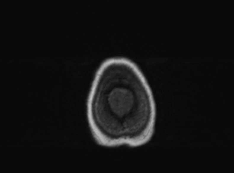 Bilateral PCA territory infarction - different ages (Radiopaedia 46200-51784 Axial T1 109).jpg