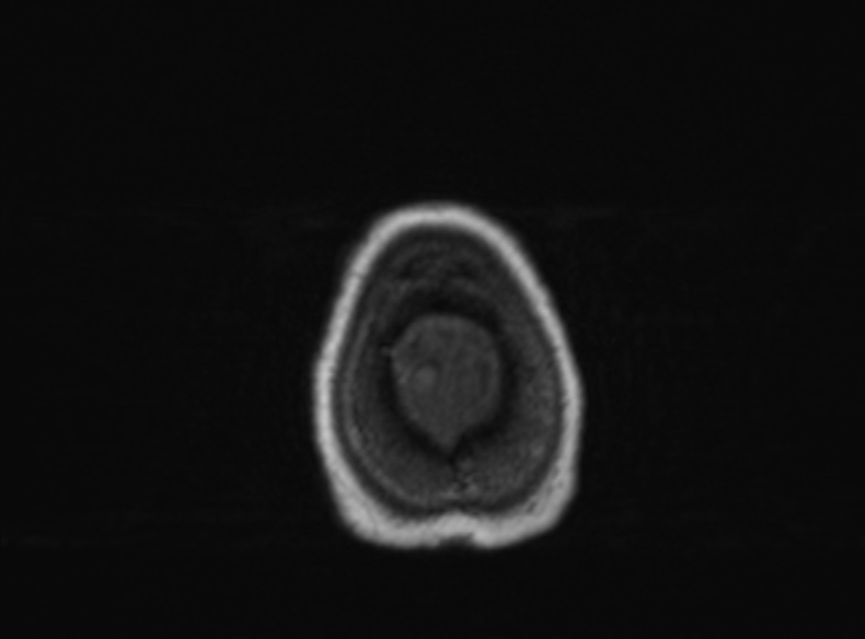 Bilateral PCA territory infarction - different ages (Radiopaedia 46200-51784 Axial T1 112).jpg