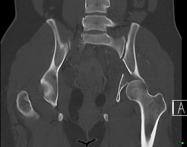 File:Bilateral acetabular fractures (Radiopaedia 79272-92308 Coronal bone window 23).jpg