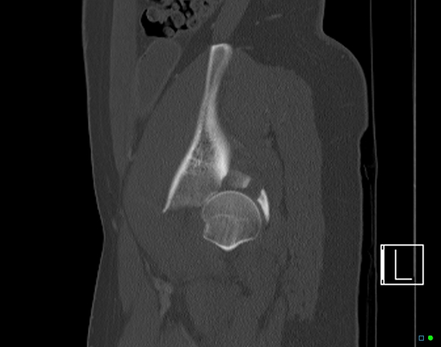 Bilateral acetabular fractures (Radiopaedia 79272-92308 Sagittal bone window 70).jpg