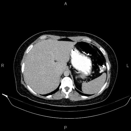 Bilateral adrenal myelolipoma (Radiopaedia 63058-71535 Axial C+ delayed 11).jpg