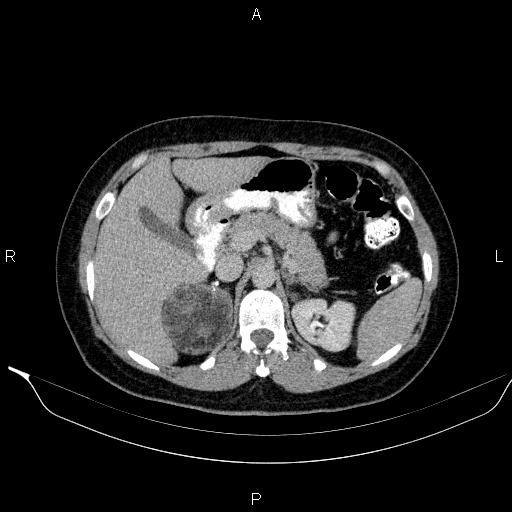 File:Bilateral adrenal myelolipoma (Radiopaedia 63058-71535 Axial C+ delayed 27).jpg