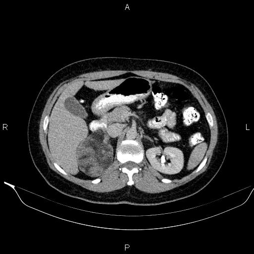 File:Bilateral adrenal myelolipoma (Radiopaedia 63058-71535 Axial C+ delayed 34).jpg