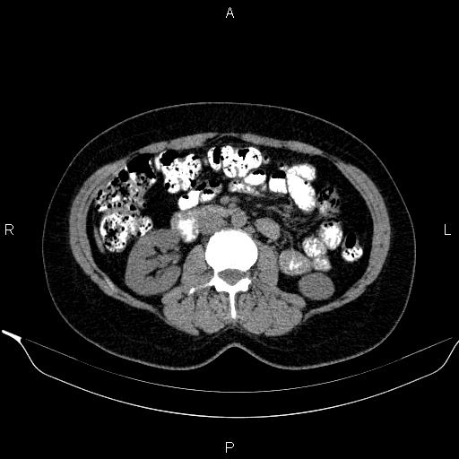 Bilateral adrenal myelolipoma (Radiopaedia 63058-71535 Axial non-contrast 83).jpg