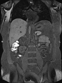 Bilateral adrenal myelolipoma (Radiopaedia 63058-71537 Coronal T1 fat sat 52).jpg