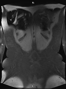 Bilateral adrenal myelolipoma (Radiopaedia 63058-71537 Coronal T1 fat sat 9).jpg