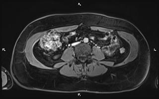 Bilateral adrenal myelolipoma (Radiopaedia 63058-71537 H 68).jpg
