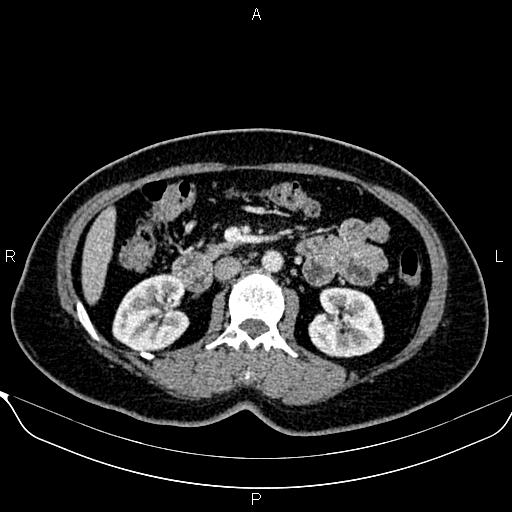 Bilateral benign adrenal adenomas (Radiopaedia 86912-103124 B 50).jpg