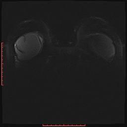File:Bilateral breast implant rupture (Radiopaedia 24761-25027 PASTA Si IR 22).jpg
