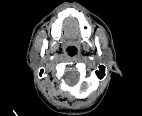 Bilateral carotid body tumors (Radiopaedia 61841-69870 Axial non-contrast 17).jpg
