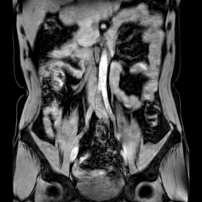Bilateral conjoined nerve roots at different levels (Radiopaedia 73312-84063 Coronal WE 3).jpg