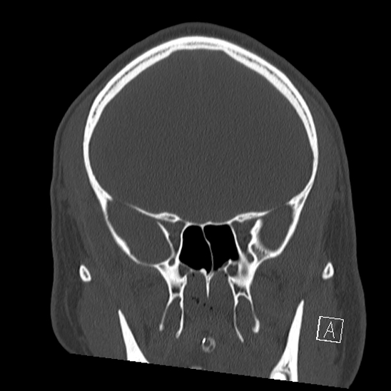 Bilateral occipital condyle fracture (type 2) (Radiopaedia 87675-104089 Coronal bone window 36).jpg