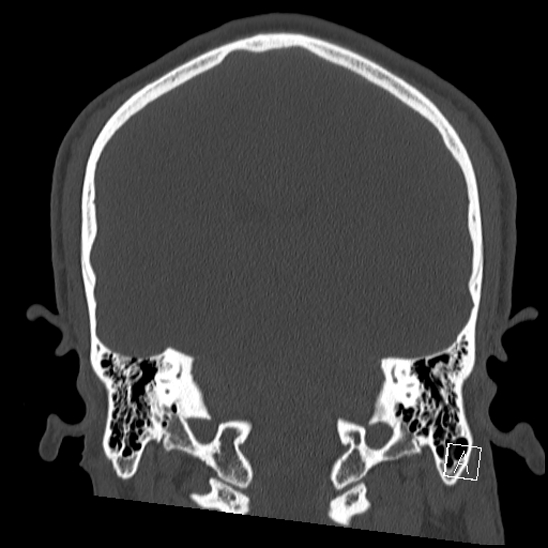 Bilateral occipital condyle fracture (type 2) (Radiopaedia 87675-104089 Coronal bone window 84).jpg
