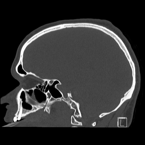 Bilateral occipital condyle fracture (type 2) (Radiopaedia 87675-104089 Sagittal bone window 67).jpg