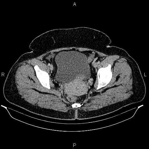 Bilateral ovarian dermoid cysts (Radiopaedia 85785-101603 A 97).jpg