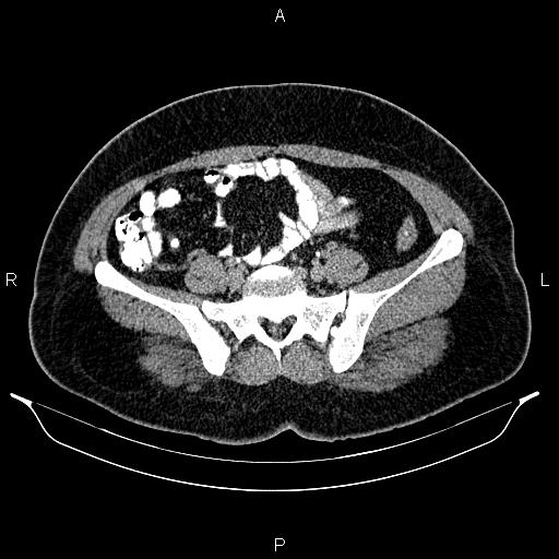 File:Bilateral ovarian dermoid cysts (Radiopaedia 85785-101603 Axial C+ delayed 57).jpg