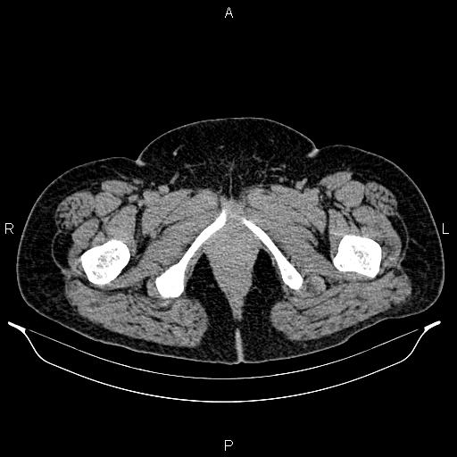 Bilateral ovarian dermoid cysts (Radiopaedia 85785-101603 Axial C+ delayed 94).jpg