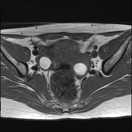 File:Bilateral ovarian endometriomas (Radiopaedia 87085-103347 Axial T1 9).jpg