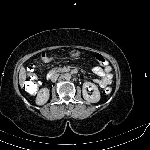 Bilateral ovarian serous cystadenocarcinoma (Radiopaedia 86062-101989 Axial C+ delayed 26).jpg