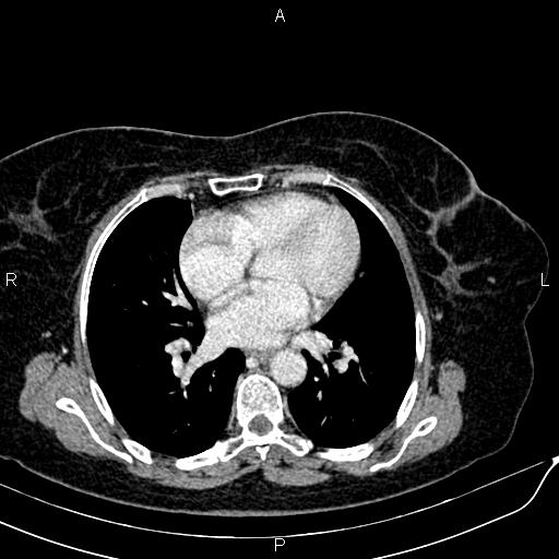 Bilateral ovarian serous cystadenocarcinoma (Radiopaedia 86062-101989 B 2).jpg