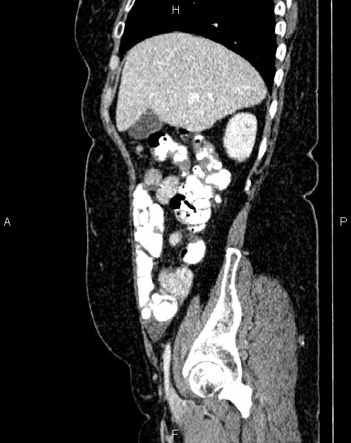Bilateral ovarian serous cystadenocarcinoma (Radiopaedia 86062-101989 E 17).jpg