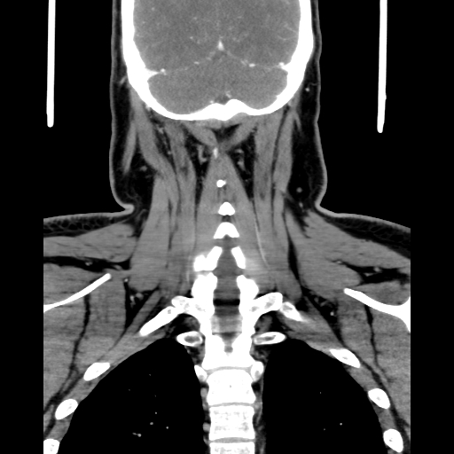 Bilateral peritonsillar abscess (Radiopaedia 85065-100610 Coronal 59).jpg