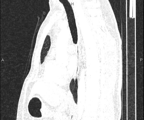 Bilateral pulmonary AVM (Radiopaedia 83134-97505 Sagittal lung window 61).jpg