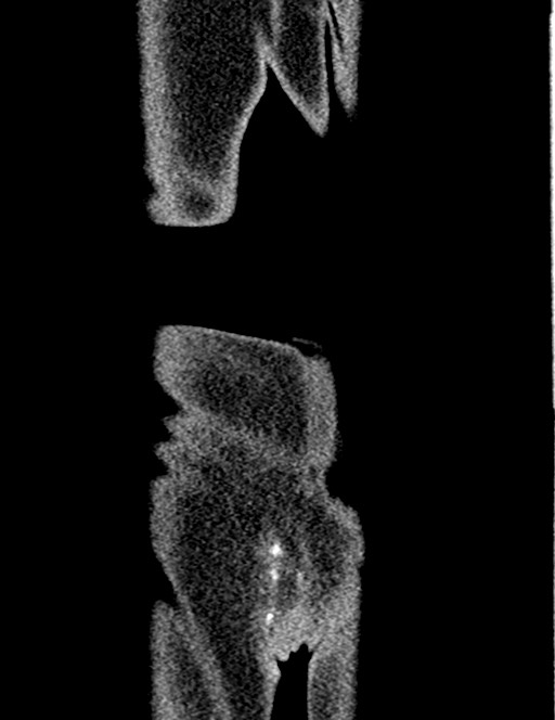 Bilateral staghorn calculi (Radiopaedia 59475-66842 Coronal non-contrast 97).jpg